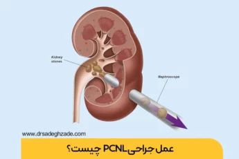عمل pcnl