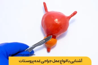 عمل جراحی پروستات