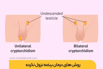 عکس بیضه نزول نکرده