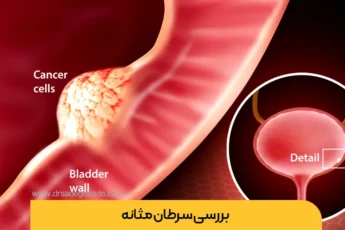 عکس سرطان مثانه