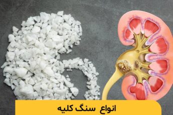 انواع سنگ کلیه