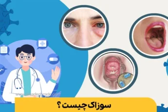سوزاک چیست