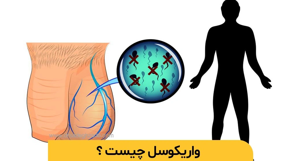 واریکوسل چیست
